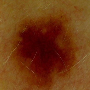 Dermatoscope - l'observation de la peau Firefly DE300 20111203-1592