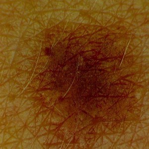 Dermatoscope - l'observation de la peau b- Firefly DE300 20111203-1592 20111203-1593