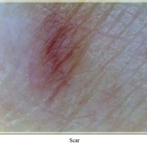 La vidéomicroscopie numérique à épiluminescence - Firefly Dermatoscope - scar