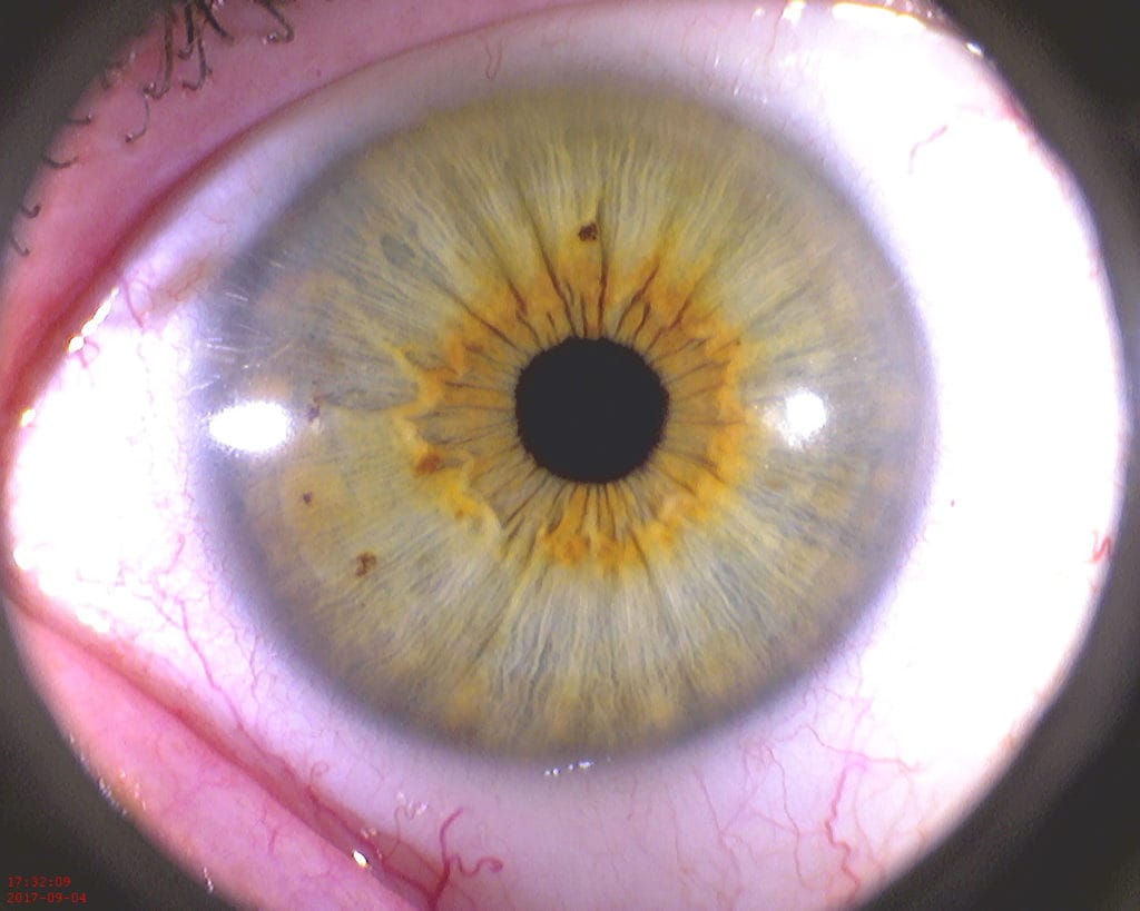 Iridologie – Iridologue – Iriscope – Iridoscope